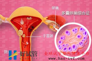 多囊想做试管这几个问题看完心里有谱了!(图4) 多囊想做试管这几个问题看完心里有谱了!(图4)
