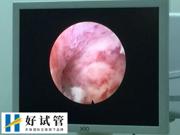 宫腔镜检查是一种重要的妇科检查方法